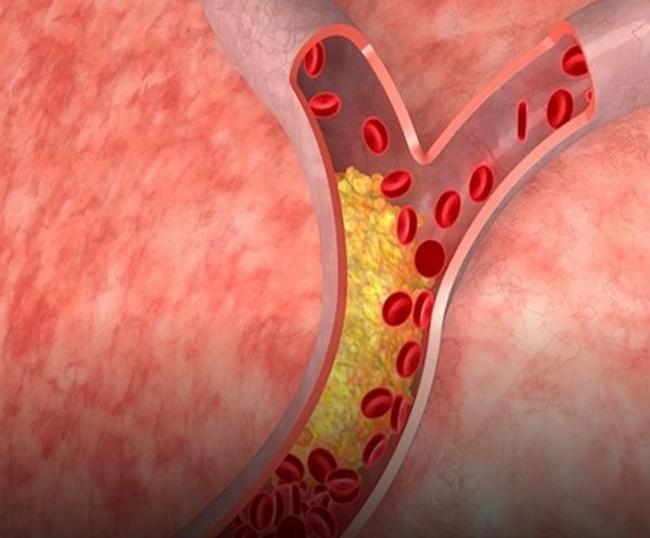 ما هو أفضل فطور لمرضى الكوليسترول؟