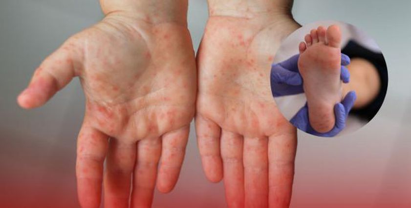 عدوى منتشرة تشبه الجدري وترعب الأمهات.. تعرف على فيروس كوكساكي