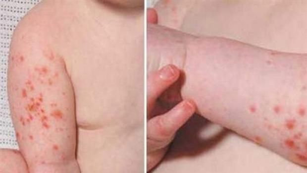 عاجل: عدوى منتشرة تشبه الجدري وترعب الأمهات.. تعرف على فيروس كوكساكي