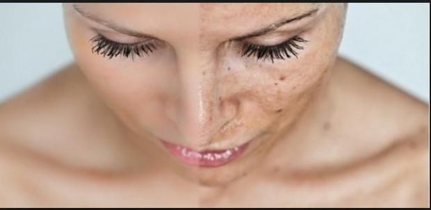 طرق فعالة لحماية البشرة من التصبغات الشمسية والبقع الجلدية في الصيف