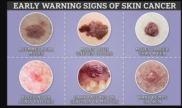 إصابة لاعبة كمال أجسام بسرطان قاتل.. احذر ظهور شامة غريبة