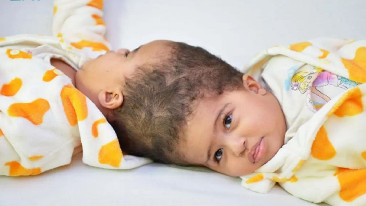 نجاح عملية فصل التوأم الملتصق الإريتري أسماء وسمية بعد عملية جراحية دقيقة