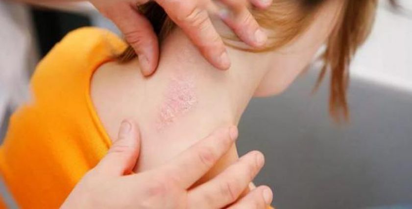 عاجل .. علامة غريبة تشير إلى الإصابة بأخطر أنواع سرطان الجلد.. لاحظها فورا