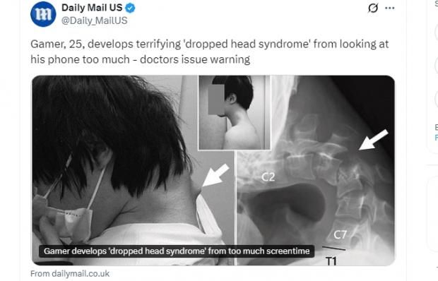 تعرض شاب لإصابة مرعبة بسبب لعبة إليكترونية.. فقد القدرة على رفع رأسه