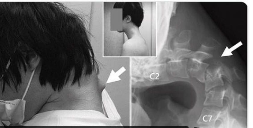 تعرض شاب لإصابة مرعبة بسبب لعبة إليكترونية.. فقد القدرة على رفع رأسه