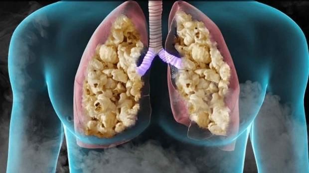 مرض نادر لا علاج له .. تحذير لمدخني السجائر الإلكترونية من «رئة الفشار»