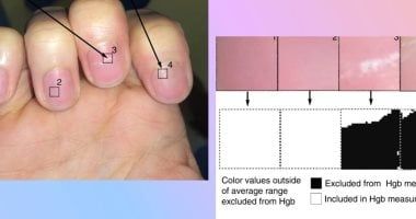 تكنولوجيا: تطبيق جديد مدعوم بالذكاء الاصطناعي يكشف إذا كنت مصابًا بفقر الدم من تصوير أظافرك