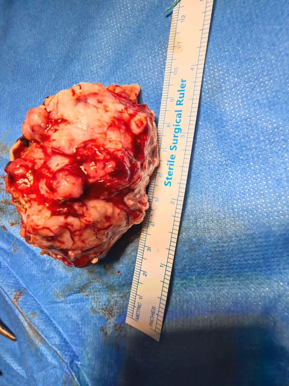 جراحة دقيقة تنقذ حاجة إندونيسية من ورم دماغي في المدينة المنورة 