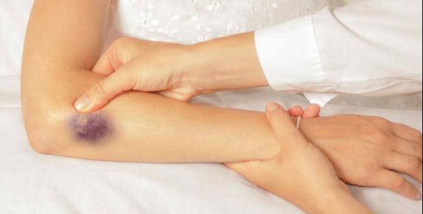 ظهور كدمات في الجسم.. تعرف على أعراض وطرق تشخيص مرض «الهيموفيليا ب»