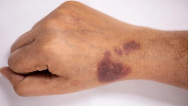 ظهور كدمات في الجسم.. تعرف على أعراض وطرق تشخيص مرض «الهيموفيليا ب»