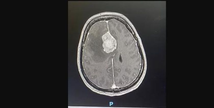 علامات شائعة تشير إلى الإصابة بورم خطير في الدماغ