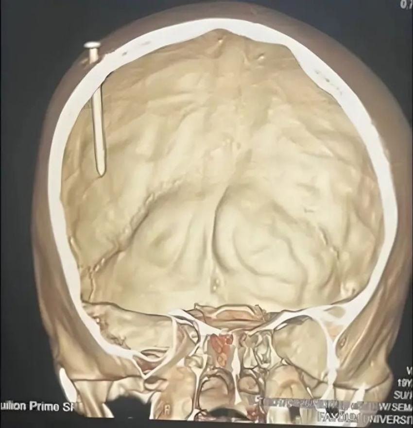 الامارات | 5 ساعات في غرفة العمليات لإخراج مسمار من دماغ طفل مصري