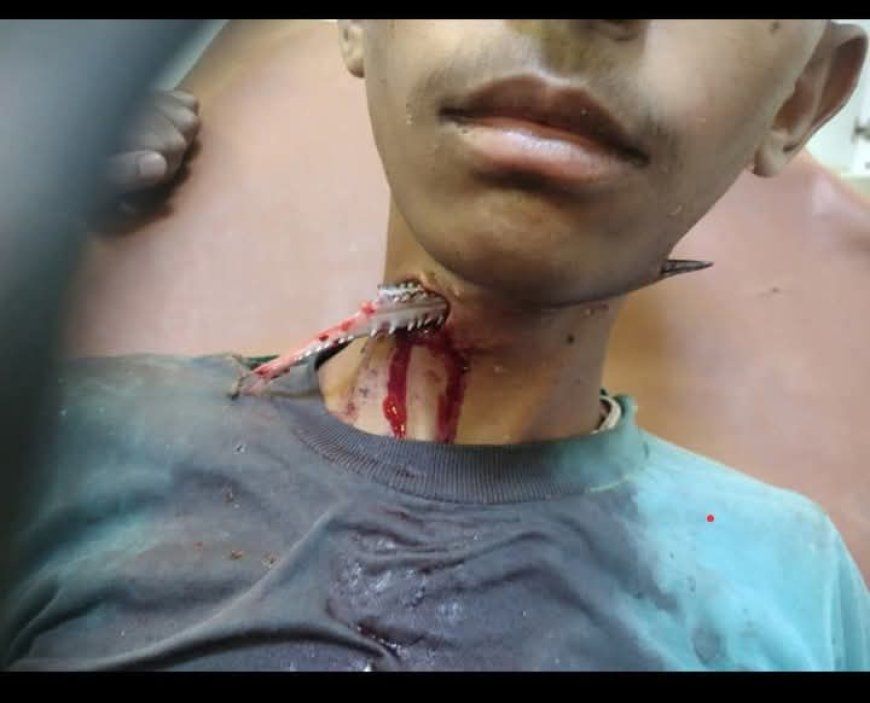 عاجل: شاهد حادثة نادرة..إصابة صياد في المخا إثر اختراق "حوت الخرم" لعنقه(صورة)