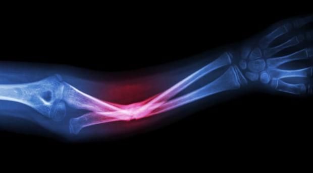 بعد إصابة نجوى فؤاد في ذراعها.. نصائح لتسريع التعافي وتفادي المضاعفات