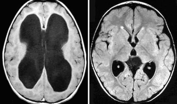 تعرف على مرض بيلي جويل.. الأعراض تختلف حسب العمر