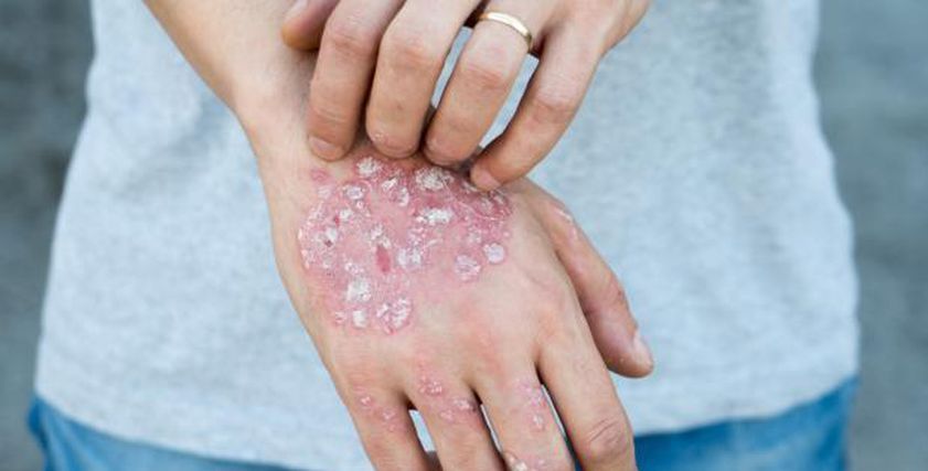 مرض جلدي مزمن يهددك بسبب دهون البطن.. احذر الأعراض