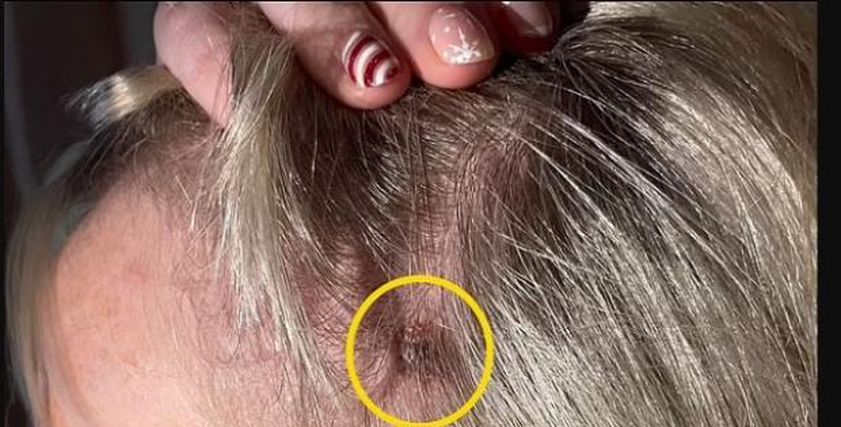 علامة بسيطة في الرأس قد تشير لأخطر أنواع سرطان الجلد.. راقبها جيدا
