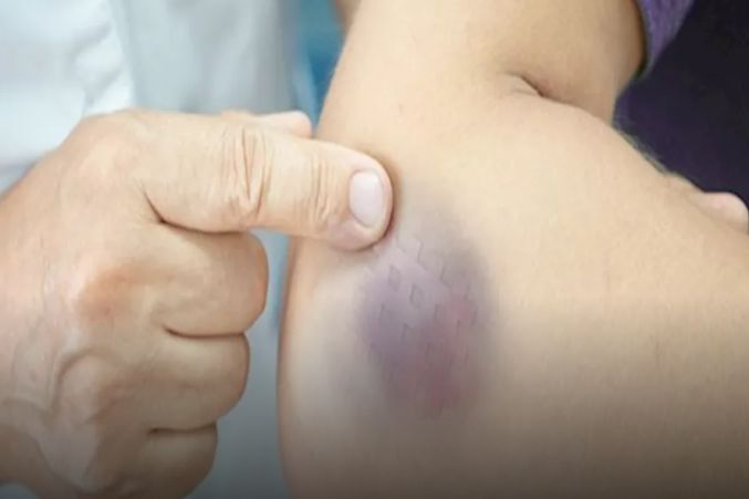 9 أسباب وراء ظهور بقع حمراء في الجسم- هذه طرق علاجها