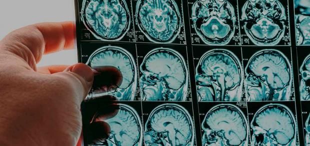 مرض عدواني يهاجم الدماغ بشراسة ويتحدى العلاج.. معلومات عن الورم الأورومي الدبقي