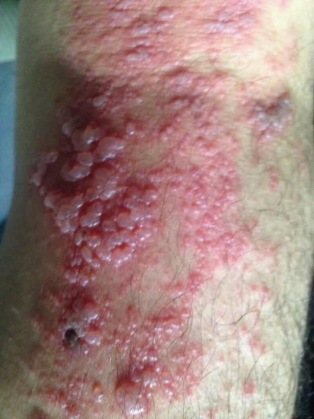 «العوز المناعي» يجتاح دولة آسيوية.. تفاصيل فيروس قاتل يبدأ بأعراض تشبه الإنفلونزا