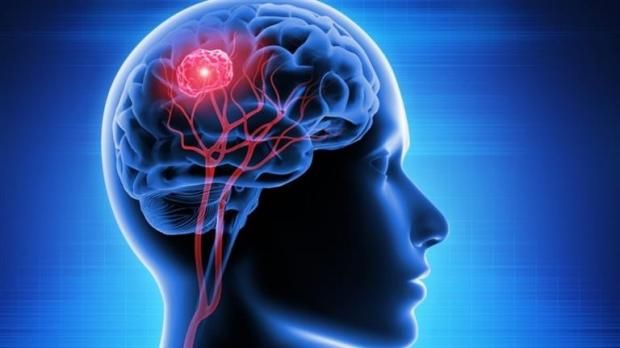 عاجل.. مرض عدواني يهاجم الدماغ بشراسة ويتحدى العلاج.. معلومات عن الورم الأورومي الدبقي