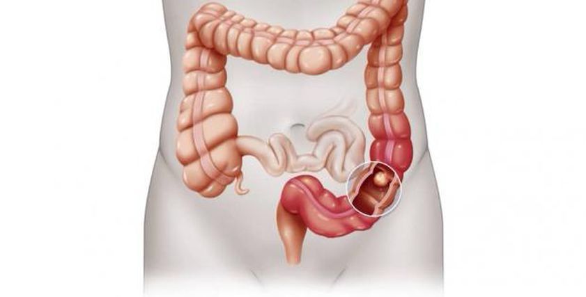 عادة يومية تقلل معدلات الوفاة بسرطان القولون.. و7 أعراض تثير القلق