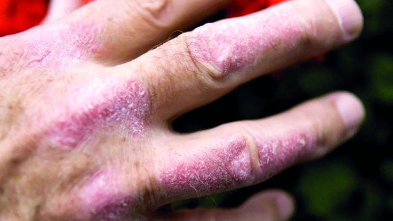 الامارات | التغذية الصحية تخفف متاعب مرضى الصدفية