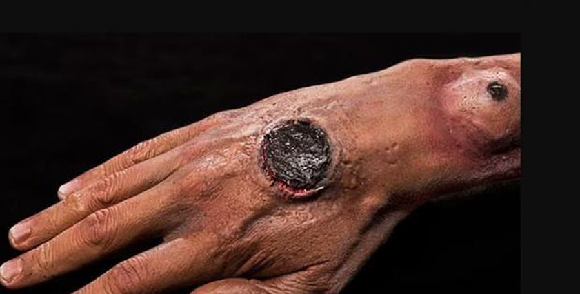 بعد وفاة شخص في تايلاند.. ما مرض الجمرة الخبيثة القاتل؟