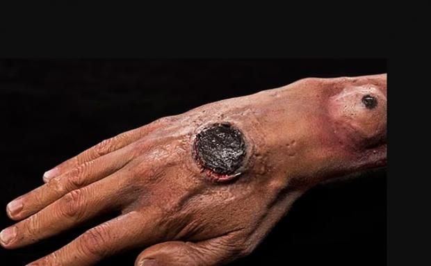 بعد وفاة شخص في تايلاند.. ما مرض الجمرة الخبيثة القاتل؟