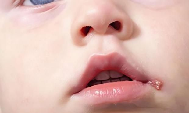 عدوى بسيطة قد تسبب مشكلات عصبية للأطفال الرضع.. تعرف عليها