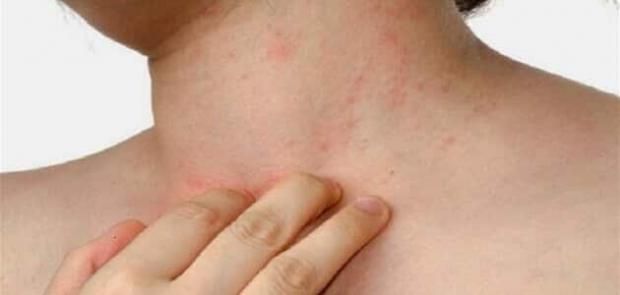 لا تفعلها أثناء الجو الحار.. أخطاء شائعة تسبب الحكة في الصيف