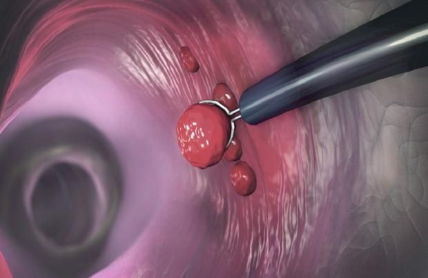 ورم نادر يهدد جيل الألفية.. ينتشر أسرع من سرطان القولون