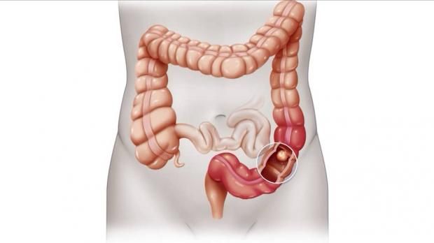 تعرف على مرض كلوي ميدوزن نجمة برنامج «TheOnly Way Is Essex».. ما أعراضه؟