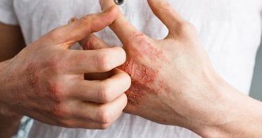 طرق إيقاف حكة الإكزيما.. كيف يساعد تقليل التوتر