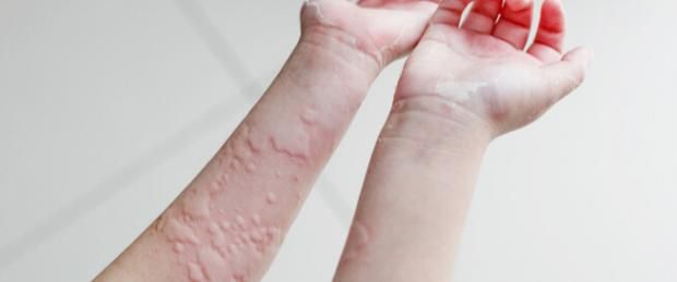 إليك الأسباب وطرق العلاج.. مرض ملك أحمد زاهر