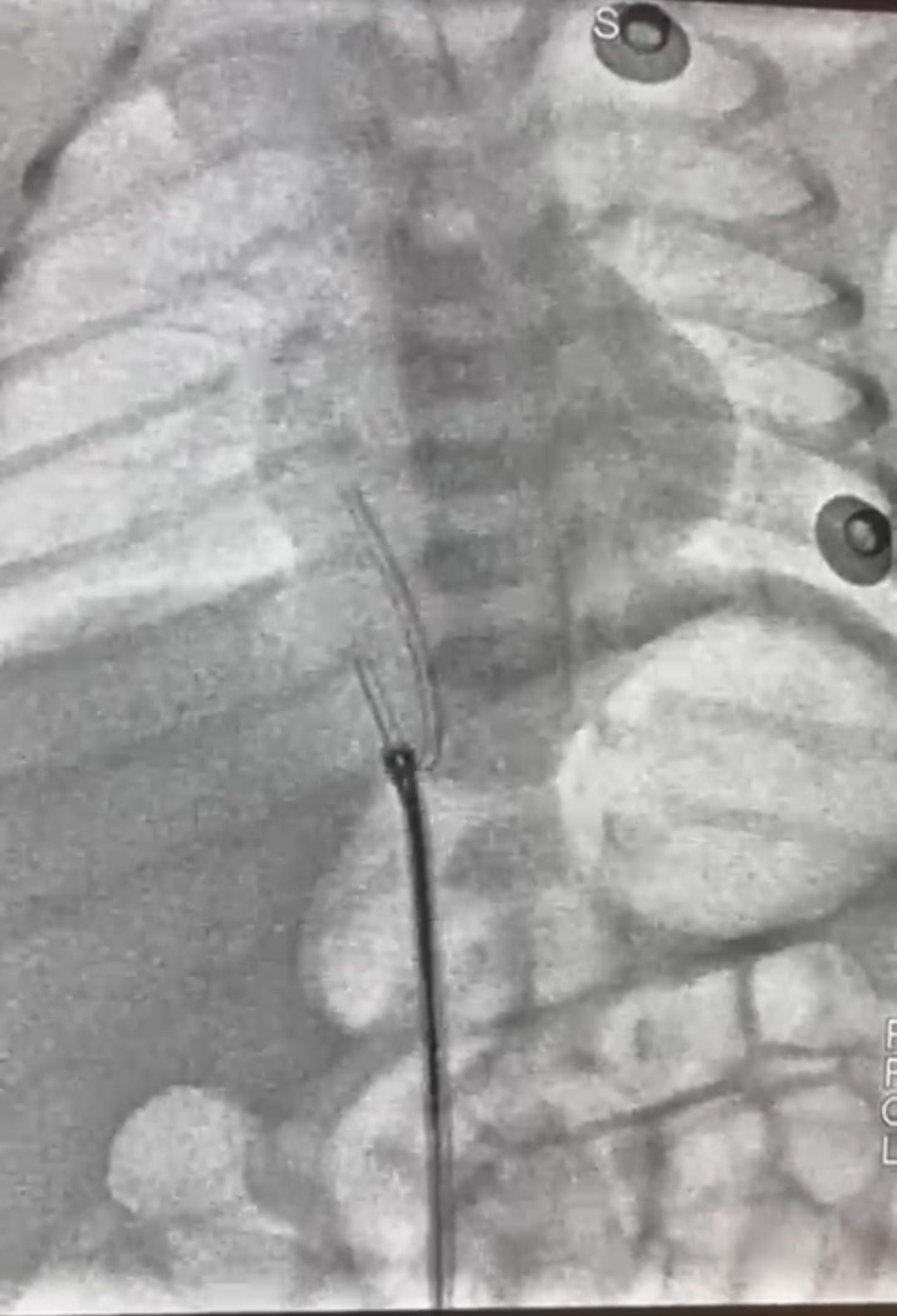 عمره 5 أيام.. التدخل الطبى العاجل ينقذ حياة رضيع فى معهد القلب