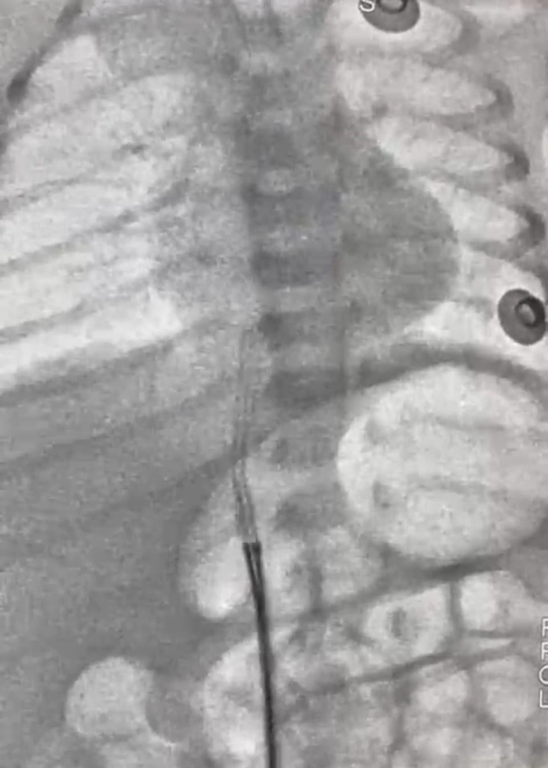 عمره 5 أيام.. التدخل الطبى العاجل ينقذ حياة رضيع فى معهد القلب