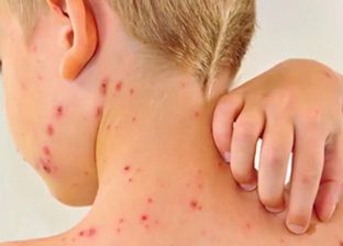 تحذيرات في بريطانيا من انتشار مرض فيروسي.. إليك الأعراض وطرق الوقاية