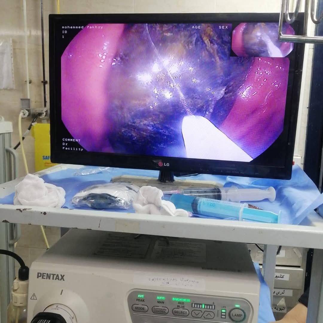 هاتف فى معدة مريض منذ عامين.. واقعة طبية نادرة بمستشفى الأزهر في أسيوط