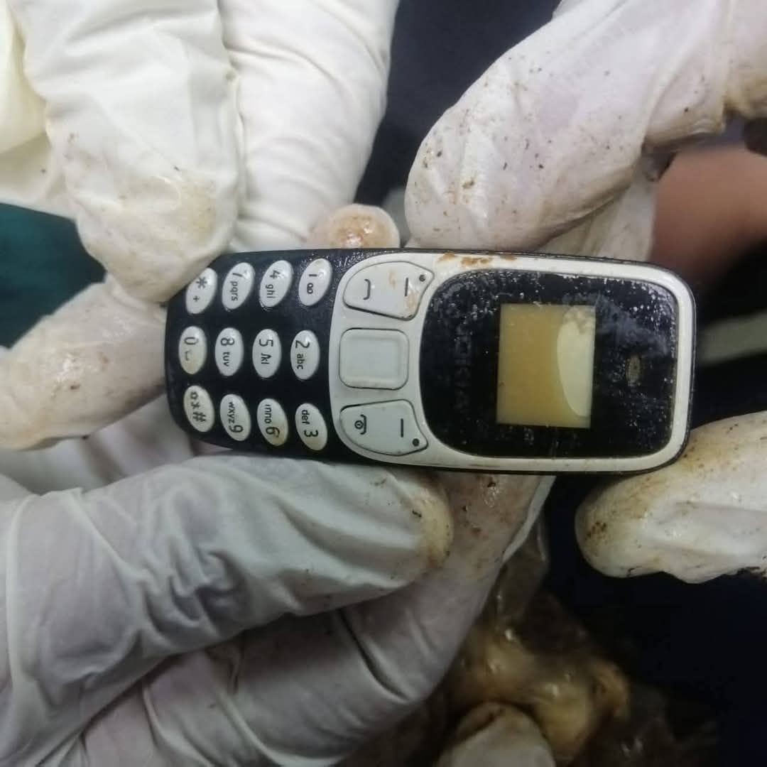 هاتف فى معدة مريض منذ عامين.. واقعة طبية نادرة بمستشفى الأزهر في أسيوط