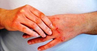 لا تصيب أكثر من 7% من المرضى.. ما هي الصدفية العكسية؟