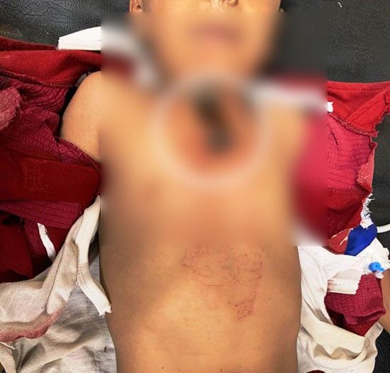 جراحة دقيقة تنقذ حياة طفل من طعنة قاتلة بالقلب بمستشفى سوهاج الجامعى.. صور