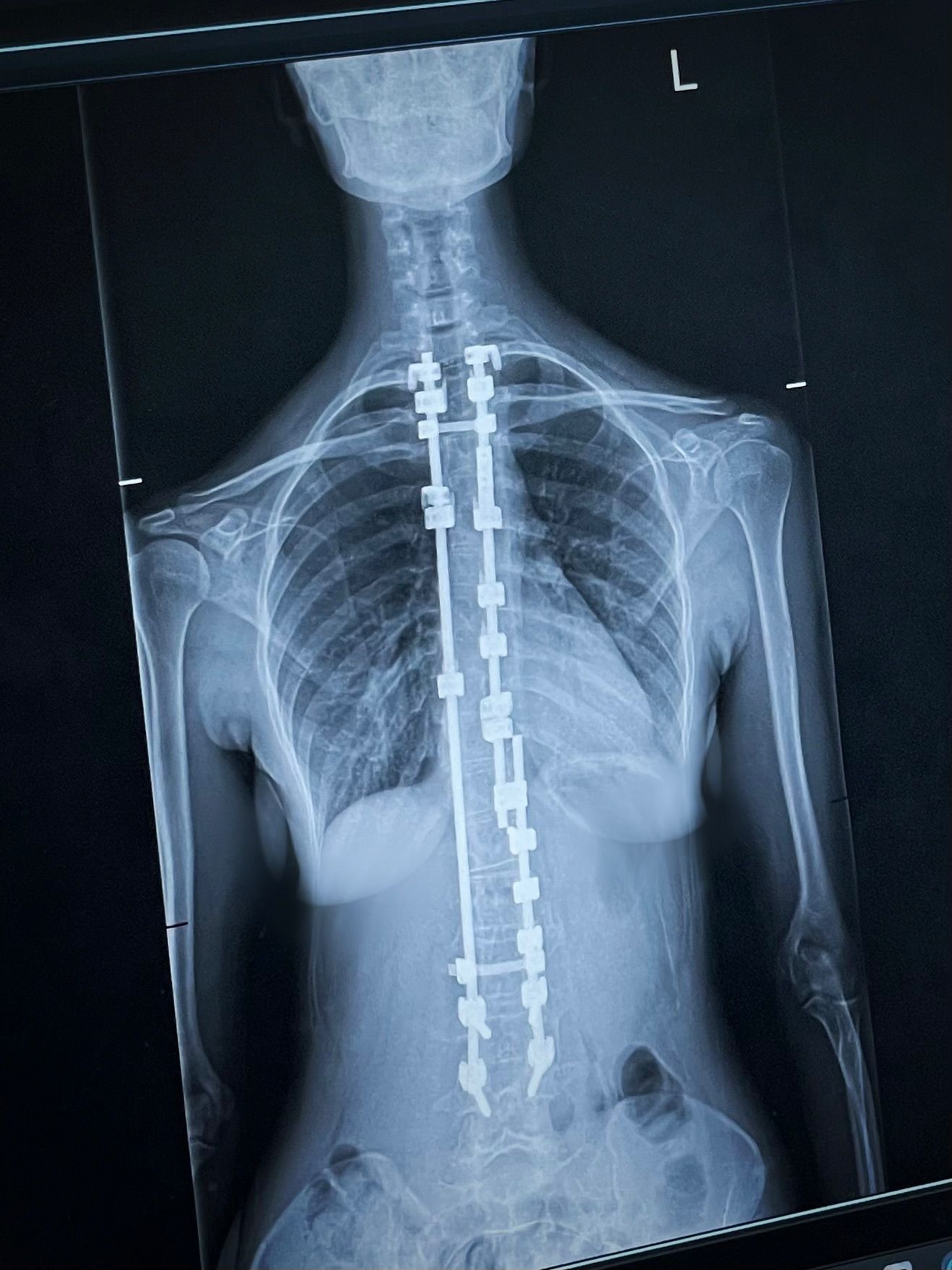 رغم الألم… زينة مكّي تكتب سطور الأمل في معركتها مع الجنف