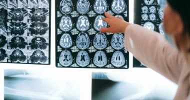 تكنولوجيا: أداة ذكاء اصطناعى تكتشف 9 أنواع من الخرف من فحص واحد بدقة 88%