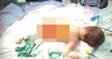 إنفاذ حياة رضيع يعانى من وجود وصلات متعددة بالشرايين بمستشفي الشيخ زايد