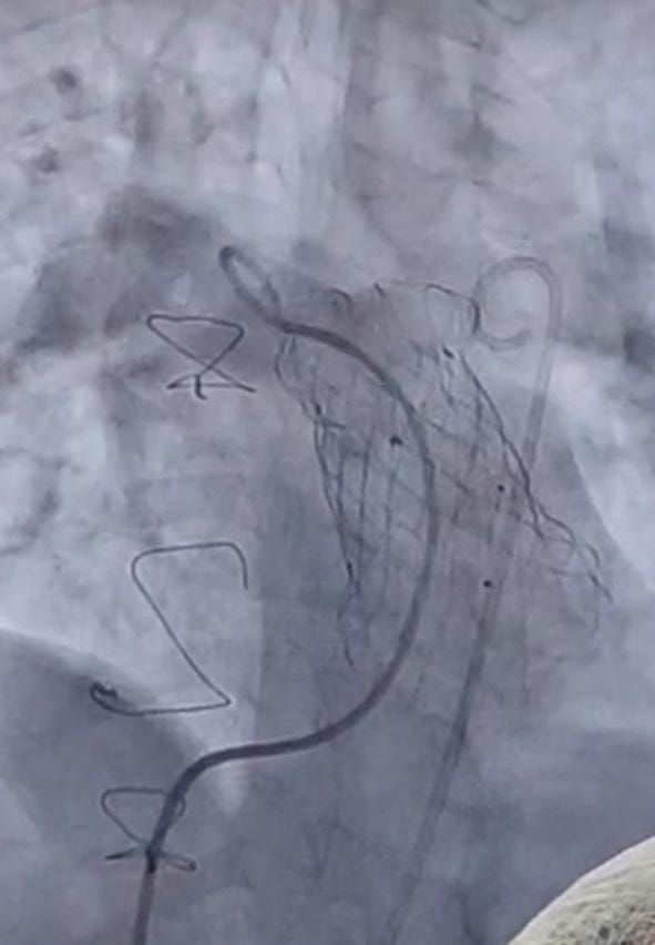 الصحة: زراعة 12 صماما رئويا بالقسطرة التداخلية العلاجية مجانا بمعهد القلب