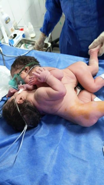 ولادة نادرة لتوأم ملتصق بمستشفى الفيوم العام (صورة)