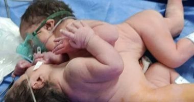 ولادة نادرة لتوأم ملتصق بمستشفى الفيوم العام (صورة)