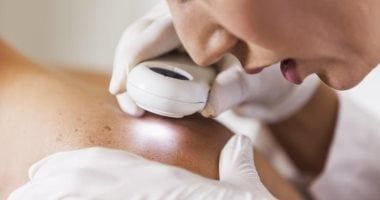 "يظهر بأماكن نادرة التعرض للشمس".. ما هى النقاط العمياء للإصابة بسرطان الجلد