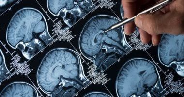 دراسة..اكتشاف طفرة جينية قد تحمي من مرض الزهايمر